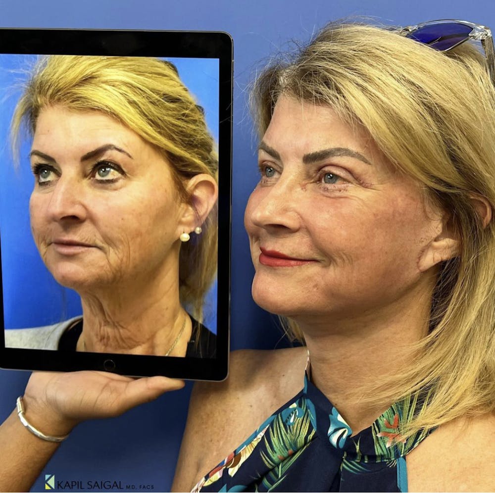 Facelift & Neck Lift Before & After Gallery - Patient 152806 - Image 1