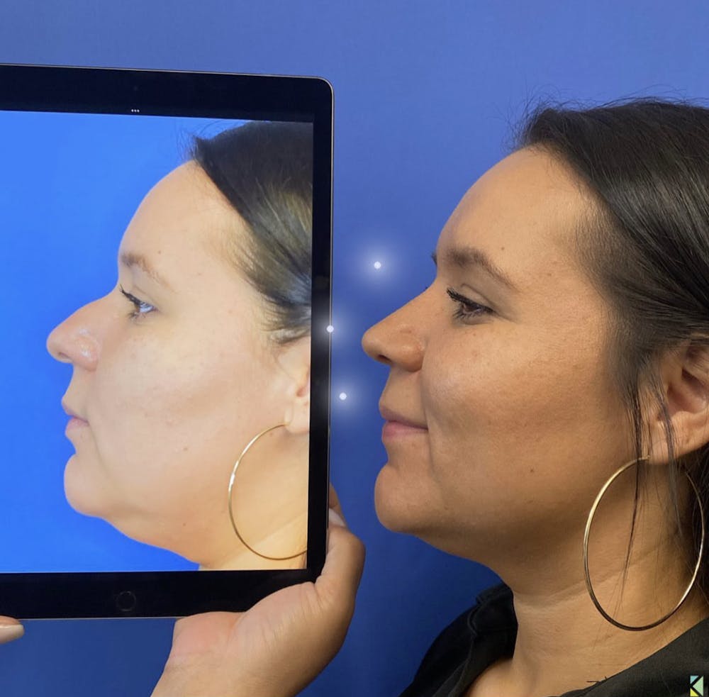 Rhinoplasty Before & After Gallery - Patient 357248 - Image 1