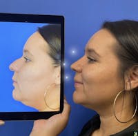 Rhinoplasty Before & After Gallery - Patient 357248 - Image 1