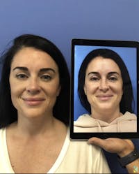 Rhinoplasty Before & After Gallery - Patient 246087 - Image 1