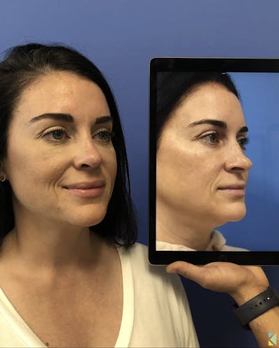 Rhinoplasty Before & After Gallery - Patient 246087 - Image 2