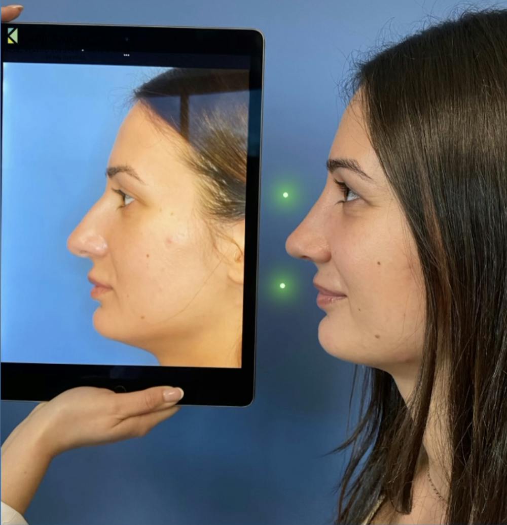 Rhinoplasty Before & After Gallery - Patient 460797 - Image 1