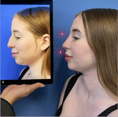 Rhinoplasty Before & After Gallery - Patient 334180 - Image 2