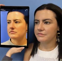 Rhinoplasty Before & After Gallery - Patient 381778 - Image 1