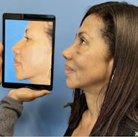Rhinoplasty Before & After Gallery - Patient 345210 - Image 1