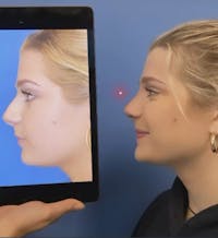 Rhinoplasty Before & After Gallery - Patient 210554 - Image 1