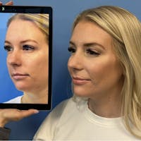 Rhinoplasty Before & After Gallery - Patient 387037 - Image 1