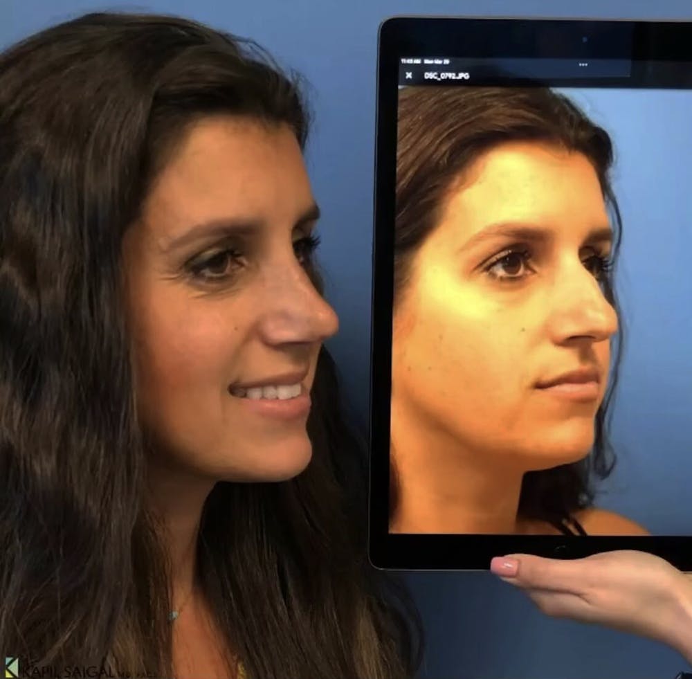 Rhinoplasty Before & After Gallery - Patient 185612 - Image 1