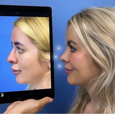 Rhinoplasty Before & After Gallery - Patient 335257 - Image 1