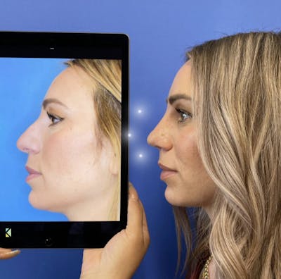 Rhinoplasty Before & After Gallery - Patient 345098 - Image 1