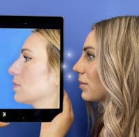 Rhinoplasty Before & After Gallery - Patient 345098 - Image 1