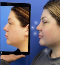 Neck Liposuction Before & After Gallery - Patient 296740 - Image 1