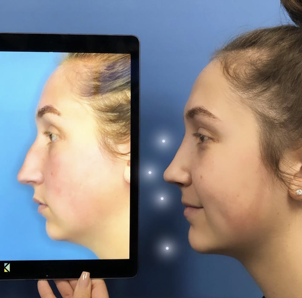 Chin Augmentation Before & After Gallery - Patient 424634 - Image 1