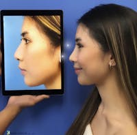 Rhinoplasty Before & After Gallery - Patient 389997 - Image 1
