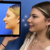 Rhinoplasty Before & After Gallery - Patient 140746 - Image 1