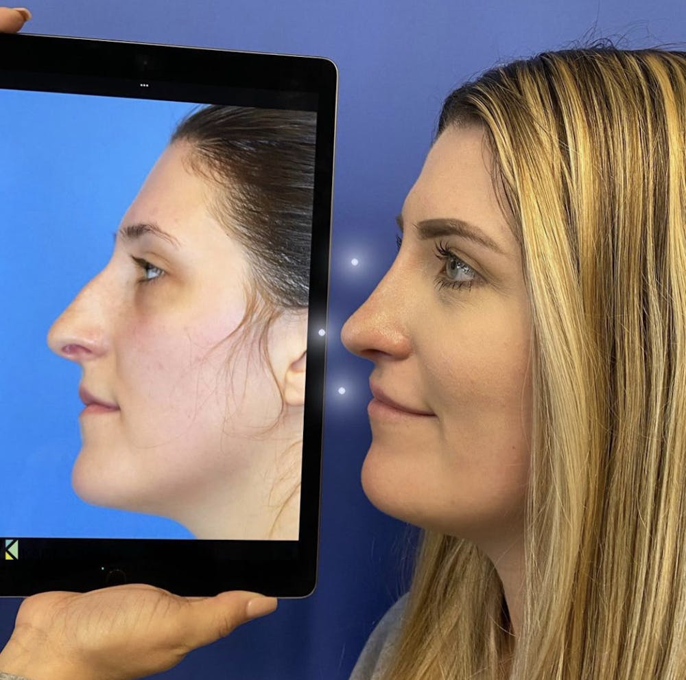 Rhinoplasty Before & After Gallery - Patient 271175 - Image 1