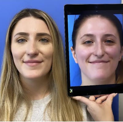 Rhinoplasty Before & After Gallery - Patient 271175 - Image 2