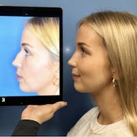 Rhinoplasty Before & After Gallery - Patient 378861 - Image 1