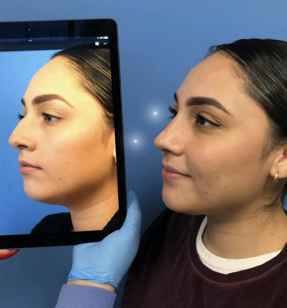 Rhinoplasty Before & After Gallery - Patient 111199 - Image 1