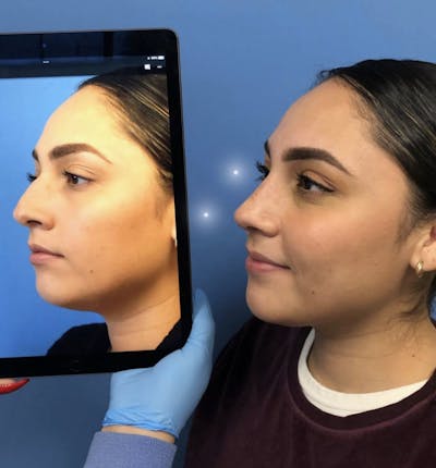 Rhinoplasty Before & After Gallery - Patient 111199 - Image 1