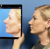 Rhinoplasty Before & After Gallery - Patient 326735 - Image 1