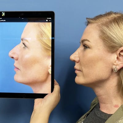 Rhinoplasty Before & After Gallery - Patient 326735 - Image 1