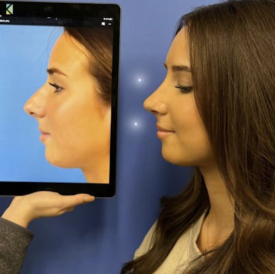Rhinoplasty Before & After Gallery - Patient 180422 - Image 1
