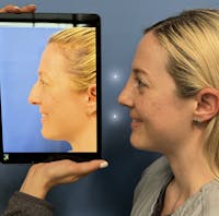 Rhinoplasty Before & After Gallery - Patient 291980 - Image 1