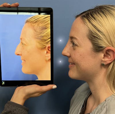 Rhinoplasty Before & After Gallery - Patient 291980 - Image 1