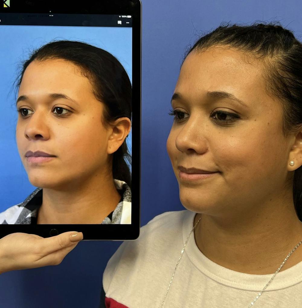 Rhinoplasty Before & After Gallery - Patient 854716 - Image 1