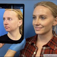 Rhinoplasty Before & After Gallery - Patient 418851 - Image 1