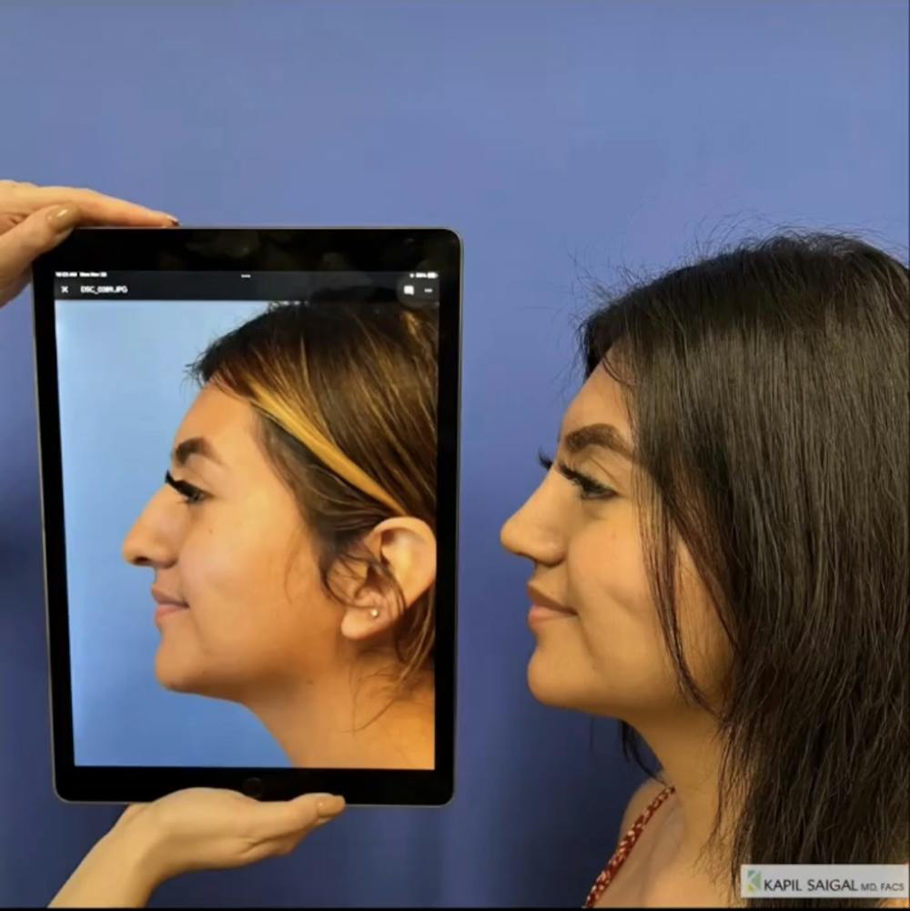Rhinoplasty Before & After Gallery - Patient 209078 - Image 1