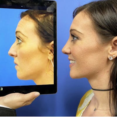 Rhinoplasty Before & After Gallery - Patient 369352 - Image 1