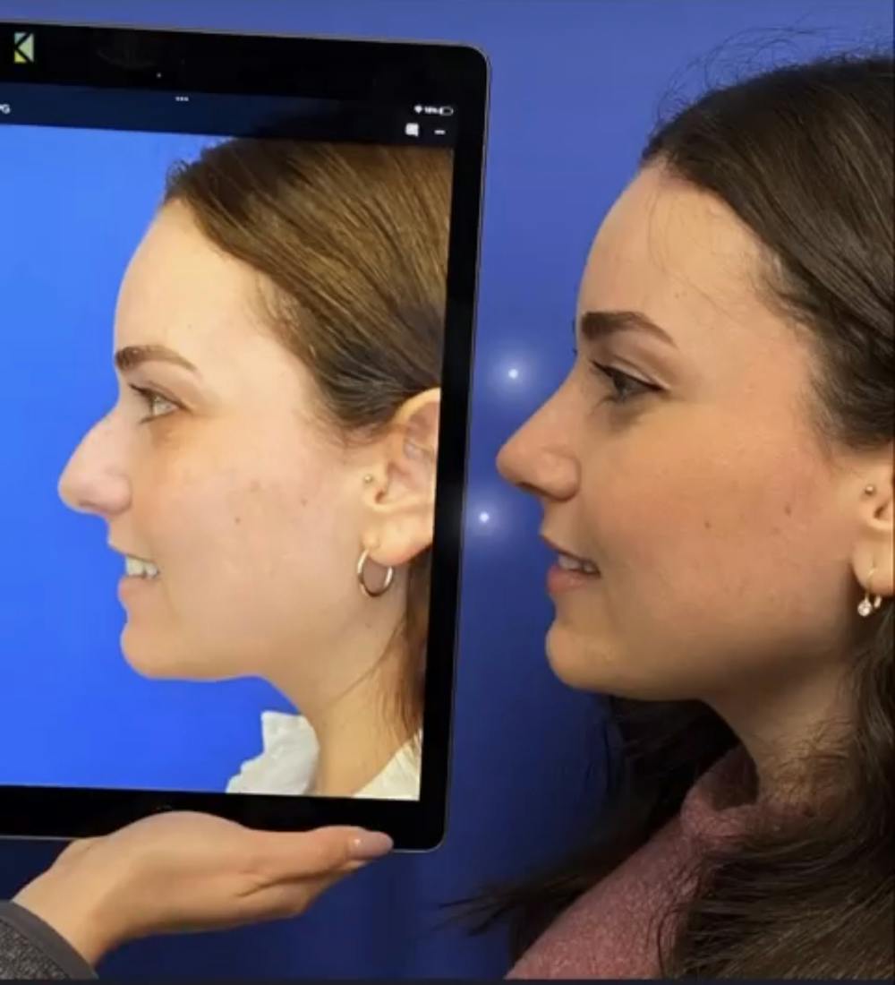 Rhinoplasty Before & After Gallery - Patient 295673 - Image 1