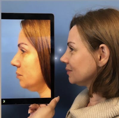 Rhinoplasty Before & After Gallery - Patient 357649 - Image 1