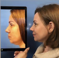 Rhinoplasty Before & After Gallery - Patient 357649 - Image 1