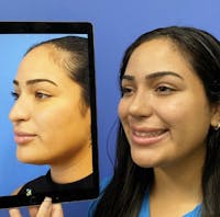 Rhinoplasty Before & After Gallery - Patient 387882 - Image 1