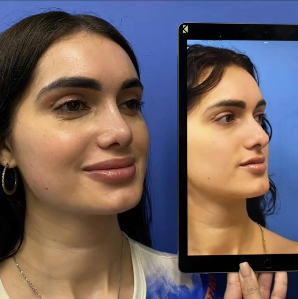 Rhinoplasty Before & After Gallery - Patient 288537 - Image 1