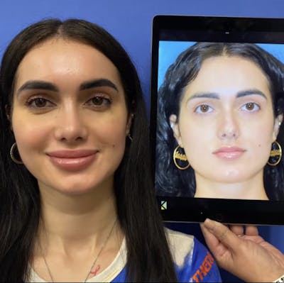 Rhinoplasty Before & After Gallery - Patient 288537 - Image 2