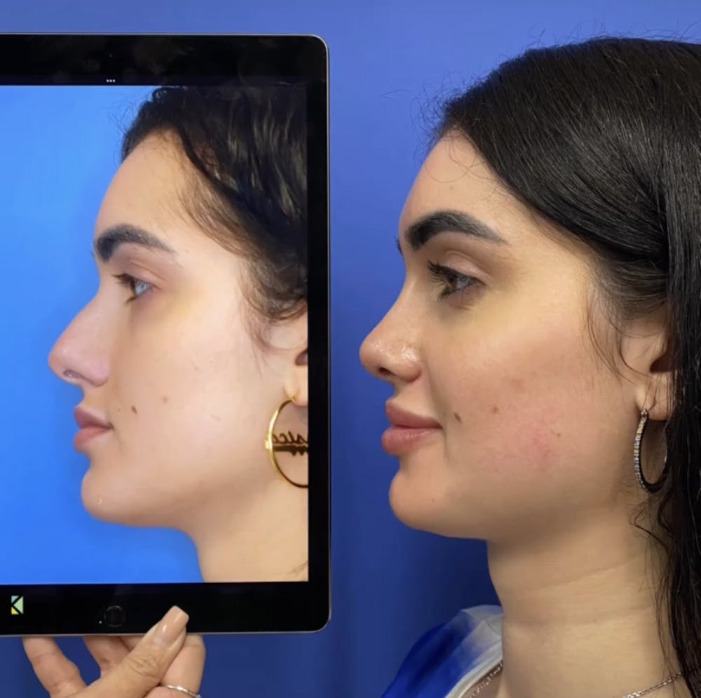 Rhinoplasty Before & After Gallery - Patient 288537 - Image 3