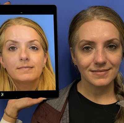 Rhinoplasty Before & After Gallery - Patient 697612 - Image 1