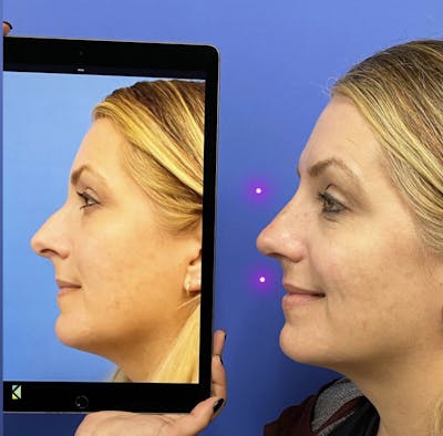 Rhinoplasty Before & After Gallery - Patient 697612 - Image 2