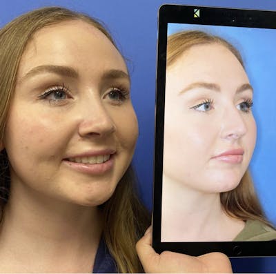 Rhinoplasty Before & After Gallery - Patient 371749 - Image 1