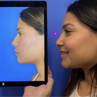 Rhinoplasty Before & After Gallery - Patient 173458 - Image 1