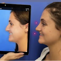 Rhinoplasty Before & After Gallery - Patient 304761 - Image 1