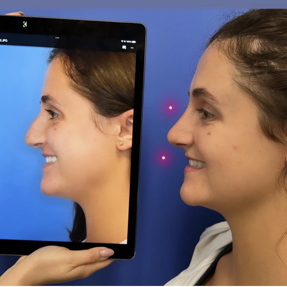 Rhinoplasty Before & After Gallery - Patient 304761 - Image 1