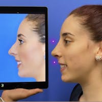 Rhinoplasty Before & After Gallery - Patient 178010 - Image 1