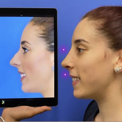 Rhinoplasty Before & After Gallery - Patient 178010 - Image 1