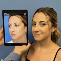 Rhinoplasty Before & After Gallery - Patient 191104 - Image 1