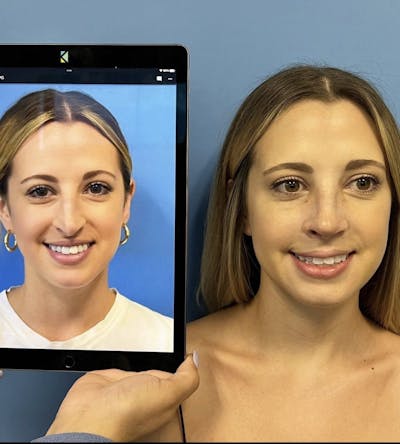 Rhinoplasty Before & After Gallery - Patient 283212 - Image 2